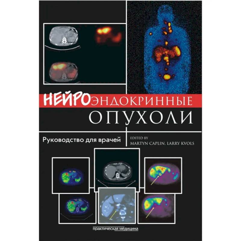 Нейроэндокринные опухоли. Руководство для врачей